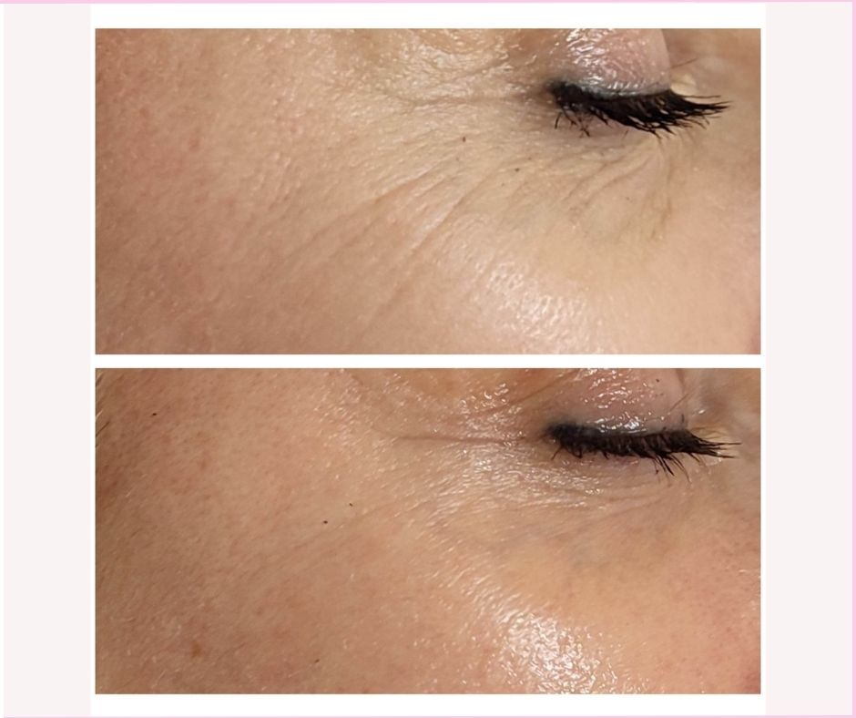 pdrn lazac mezoterapia (2)