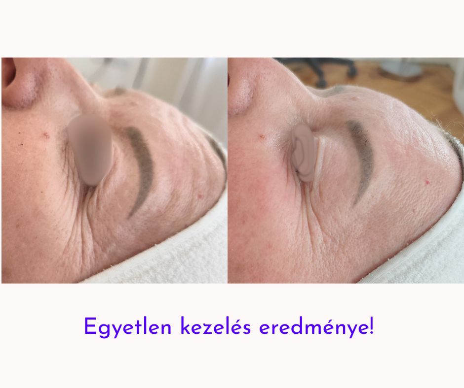 exoszóma kezelés szemráncok Budapest mesterkozmetikus