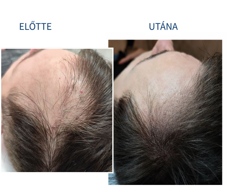 Férfi fejbőrtetoválás előtte utána Budapest