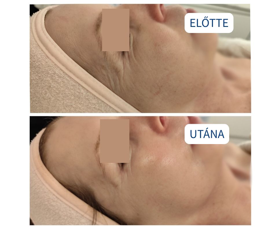 fascia előtte utána